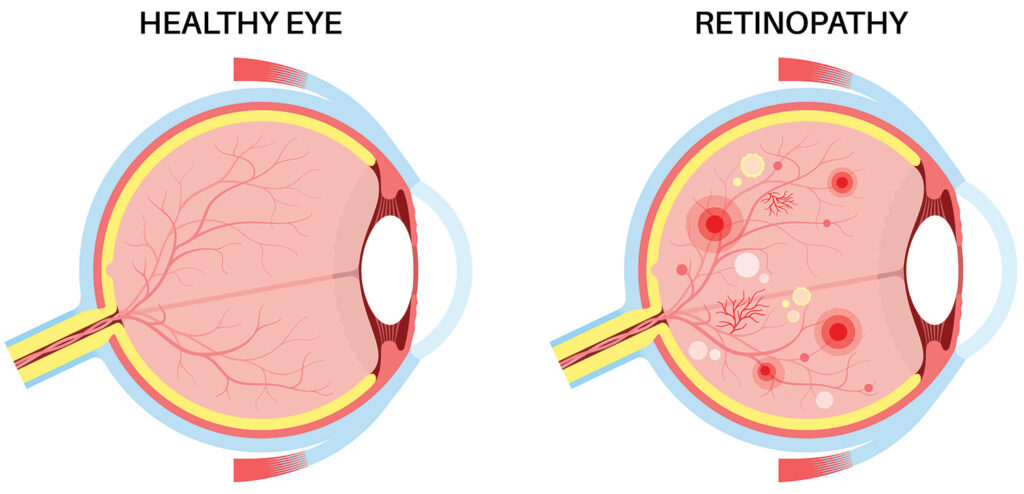 Chart illustrating a healthy eye compared to one with diabetic retinopathy