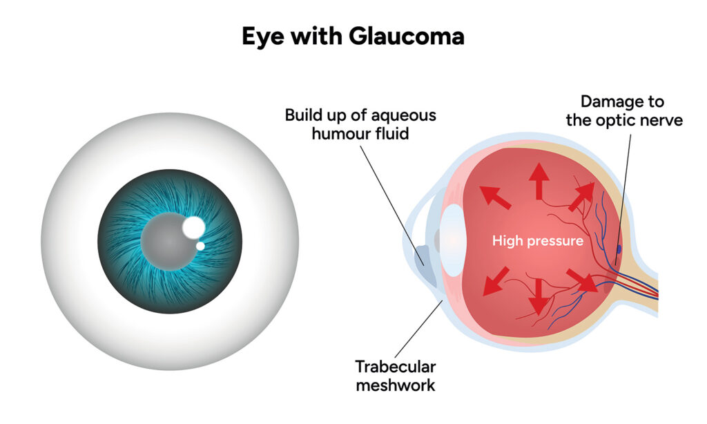 Chart illustrating a healthy eye compared to one experiencing glaucoma